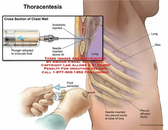 Chest Intubation