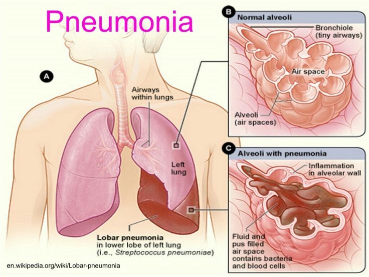 Treats Pneumothorax