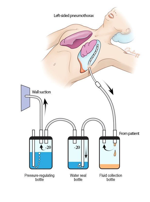 Chest Intubation