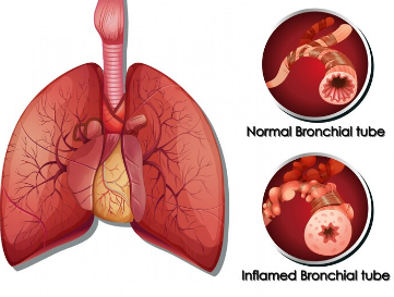 Oxygen Therapy in Pulmonary Fibrosis: Breathing Easier with Modern Solutions
