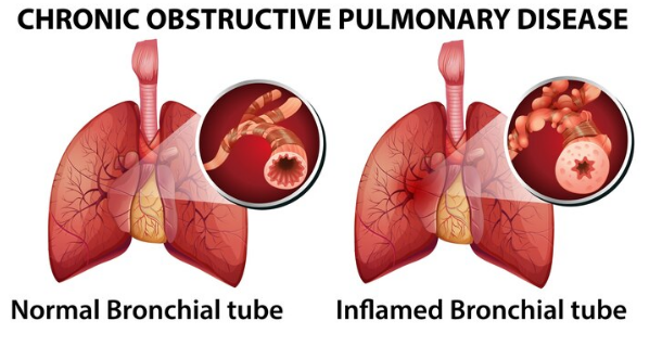 Oxygen Therapy in Pulmonary Fibrosis