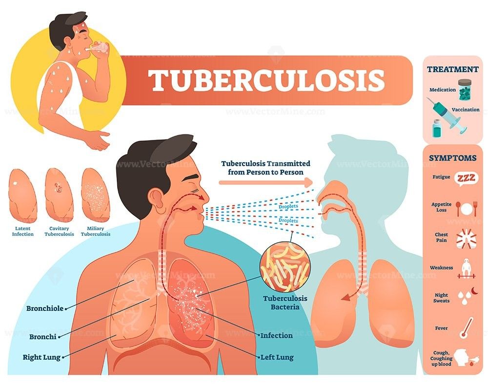 TB Effusion vs Pulmonary TB – Understanding the Difference, Symptoms, and Care