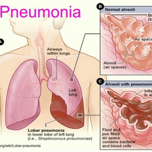Treats Pneumothorax Treats Pneumothorax